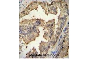 PRMT4 Antibody (Center) (ABIN655260 and ABIN2844856) immunohistochemistry analysis in formalin fixed and paraffin embedded human prostate carcinoma followed by peroxidase conjugation of the secondary antibody and DAB staining.