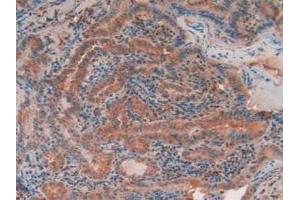 IHC-P analysis of Human Thyroid Cancer Tissue, with DAB staining. (TEK antibody  (AA 1-116))