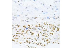 Immunohistochemistry of paraffin-embedded human lung cancer using DNMT1 antibody (ABIN7266810) at dilution of 1:100 (40x lens). (DNMT1 antibody  (AA 1-270))