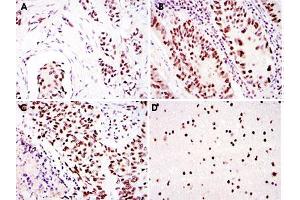 Immunohistochemical analysis of paraffin-embedded human breast cancer (A), colon cancer (B), lung cancer (C) and brain tissue (D) using PRKDC monoclonal antobody, clone 3H6  with DAB staining.