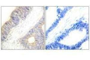 Immunohistochemistry analysis of paraffin-embedded human colon carcinoma tissue using Stefin A antibody. (CSTA antibody  (C-Term))