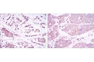 Immunohistochemical analysis of paraffin-embedded breast cancer tissues (left) and liver cancer tissues (right) using BECN1 mouse mAb with DAB staining. (Beclin 1 antibody)