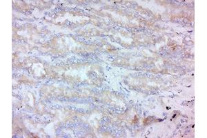 Formalin-fixed and paraffin embedded human lung carcinoma labeled with Anti-MMP-2 Polyclonal Antibody, Unconjugated  at 1:200 followed by conjugation to the secondary antibody and DAB staining. (MMP2 antibody  (AA 561-660))