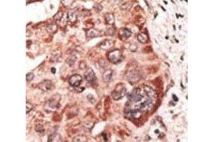 IHC analysis of FFPE human hepatocarcinoma tissue stained with the Recoverin antibody (Recoverin antibody  (AA 169-200))