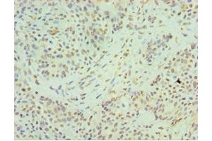 Immunohistochemistry of paraffin-embedded human breast cancer using ABIN7155133 at dilution of 1:100 (HNRNPM antibody  (AA 491-730))