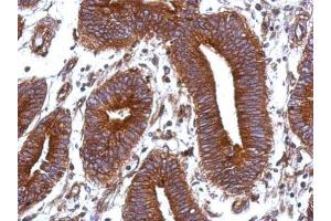 IHC-P Image Immunohistochemical analysis of paraffin-embedded human colon carcinoma, using Vitronectin, antibody at 1:500 dilution. (Vitronectin antibody)