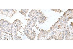 Immunohistochemistry of paraffin-embedded Human thyroid cancer tissue using LSM10 Polyclonal Antibody at dilution of 1:50(x200) (LSM10 antibody)