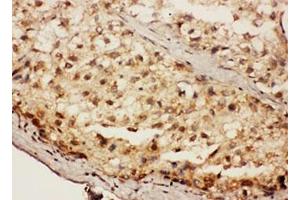 IHC testing of FFPE human liver cancer tissue with SIP antibody. (TSACC/C1orf182 antibody  (Middle Region))