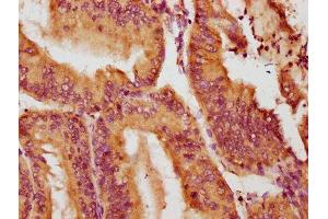 IHC image of ABIN7161004 diluted at 1:100 and staining in paraffin-embedded human endometrial cancer performed on a Leica BondTM system. (NOX1 antibody  (AA 418-564))