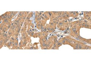 Immunohistochemistry of paraffin-embedded Human thyroid cancer tissue using BOLA1 Polyclonal Antibody at dilution of 1:35(x200)