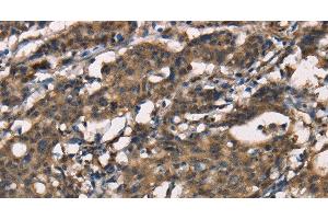 Immunohistochemistry of paraffin-embedded Human gastic cancer using SENP1 Polyclonal Antibody at dilution of 1:40 (SENP1 antibody)