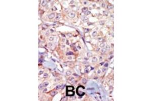 Formalin-fixed and paraffin-embedded human cancer tissue reacted with the primary antibody, which was peroxidase-conjugated to the secondary antibody, followed by AEC staining. (GSG2 antibody  (AA 323-352))