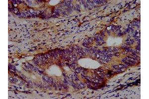 IHC image of ABIN7164019 diluted at 1:500 and staining in paraffin-embedded human colon cancer performed on a Leica BondTM system. (KCNV2 antibody  (AA 1-155))