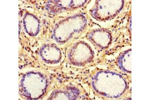 Immunohistochemistry of paraffin-embedded human gastric cancer using ABIN7157538 at dilution of 1:100 (KLRG1 antibody  (AA 60-195))