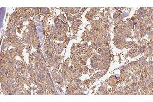 ABIN6278586 at 1/100 staining Human Melanoma tissue by IHC-P. (KLHL3 antibody  (N-Term))