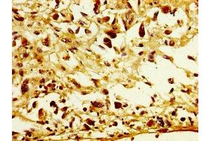 IHC image of ABIN7153729 diluted at 1:300 and staining in paraffin-embedded human melanoma performed on a Leica BondTM system. (POFUT2 antibody  (AA 125-271))