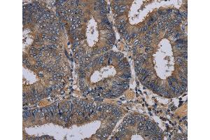 Immunohistochemistry of Human esophagus cancer using PVRL3 Polyclonal Antibody at dilution of 1:40