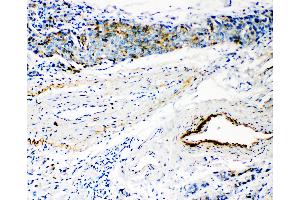 Anti-HYAL3 antibody, IHC(P) IHC(P): Human Mammary Cancer Tissue (HYAL3 antibody  (C-Term))