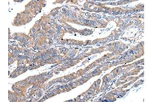 The image on the left is immunohistochemistry of paraffin-embedded Human esophagus cancer tissue using ABIN7193094(ZFAND2A Antibody) at dilution 1/30, on the right is treated with synthetic peptide. (ZFAND2A antibody)
