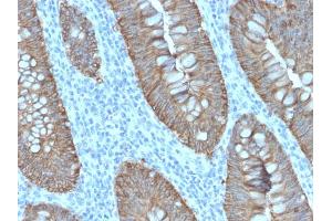 Formalin-fixed, paraffin-embedded human Colon Carcinoma stained with EpCAM Rabbit Recombinant Monoclonal Antibody (EGP40/2571R). (Recombinant EpCAM antibody  (Extracellular Domain))