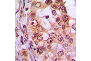 Immunohistochemical analysis of CDKL1 staining in human breast cancer formalin fixed paraffin embedded tissue section.