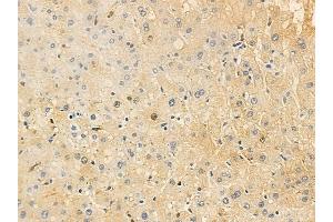ABIN6259000 and ABIN6276113 at 1/100 staining human hepatocellular carcinoma by IHC-P.