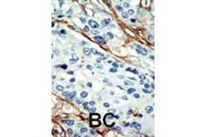 Formalin-fixed and paraffin-embedded human cancer tissue reacted with the primary antibody, which was peroxidase-conjugated to the secondary antibody, followed by DAB staining. (NUAK1 antibody  (C-Term))