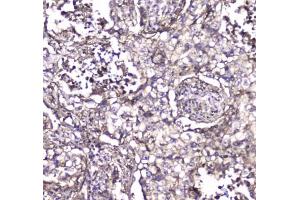 IHC testing of FFPE human rectal cancer tissue with S100A10 antibody at 1ug/ml. (S100A10 antibody)