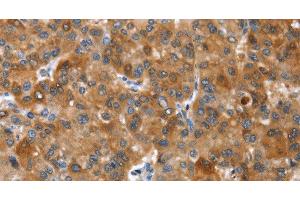 Immunohistochemistry of paraffin-embedded Human liver cancer tissue using NOD2 Polyclonal Antibody at dilution 1:40 (NOD2 antibody)