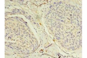Immunohistochemistry of paraffin-embedded human cervical cancer using ABIN7160712 at dilution of 1:100 (NAT8 antibody  (AA 64-227))