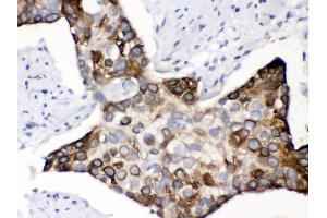 Anti- KIN Picoband antibody, IHC(P) IHC(P): Human Oesophagus Squama Cancer Tissue (KIN antibody  (AA 3-202))