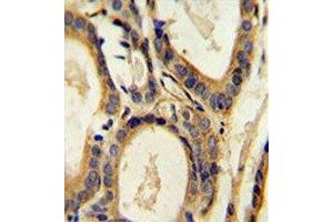 CCL4 antibody immunohistochemistry analysis in formalin fixed and paraffin embedded human prostate carcinoma. (CCL4 antibody  (AA 22-48))