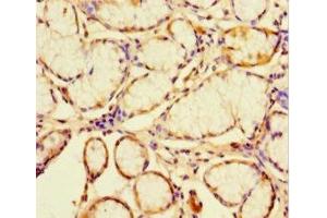 Immunohistochemistry of paraffin-embedded human gastric cancer using ABIN7147035 at dilution of 1:100 (CATSPER4 antibody  (AA 306-472))
