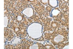 The image on the left is immunohistochemistry of paraffin-embedded Human thyroid cancer tissue using ABIN7189752(AKAP6 Antibody) at dilution 1/30, on the right is treated with synthetic peptide. (AKAP6 antibody)