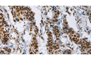 Immunohistochemistry of paraffin-embedded Human gastic cancer using IL17C Polyclonal Antibody at dilution of 1:50 (IL17C antibody)