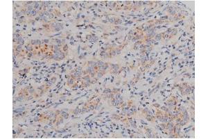 ABIN6267496 at 1/200 staining Human ganstric cancer tissue sections by IHC-P. (SNCA antibody  (pSer129))