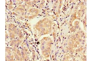 Immunohistochemistry of paraffin-embedded human liver cancer using ABIN7148885 at dilution of 1:100 (CDKN2B antibody  (AA 1-138))