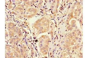 Immunohistochemistry of paraffin-embedded human liver cancer using ABIN7148885 at dilution of 1:100 (CDKN2B antibody  (AA 1-138))