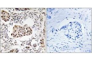 Immunohistochemistry analysis of paraffin-embedded human breast carcinoma tissue, using PPP1R11 Antibody. (PPP1R11 antibody  (AA 71-120))