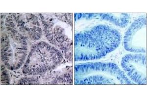 Immunohistochemistry analysis of paraffin-embedded human colon carcinoma tissue, using IKK-alpha (Ab-23) Antibody. (IKK alpha antibody  (AA 15-64))