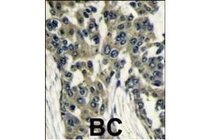 Formalin-fixed and paraffin-embedded human breast carcinoma reacted with GBL antibody (Center), which was peroxidase-conjugated to the secondary antibody, followed by DAB staining. (GBL antibody  (AA 140-170))