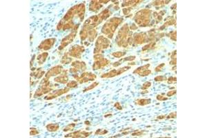 Immunohistochemical staining (Formalin-fixed paraffin-embedded sections) of human melanoma with S100 monoclonal antibody, clone 4C4.