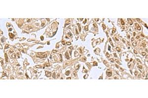 Immunohistochemistry of paraffin-embedded Human lung cancer tissue using NVL Polyclonal Antibody at dilution of 1:80(x200) (NVL antibody)
