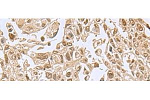 Immunohistochemistry of paraffin-embedded Human lung cancer tissue using NVL Polyclonal Antibody at dilution of 1:80(x200)