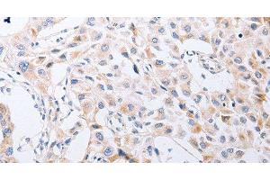 Immunohistochemistry of paraffin-embedded Human lung cancer tissue using SERP1 Polyclonal Antibody at dilution 1:30 (SERP1 antibody)