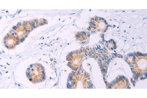 Immunohistochemistry of paraffin-embedded Human colon cancer tissue using ADCY5 Polyclonal Antibody at dilution 1:30 (ADCY5 antibody)