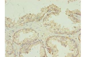 Immunohistochemistry of paraffin-embedded human prostate cancer using ABIN7173059 at dilution of 1:100 (TMEM141 antibody  (AA 1-108))