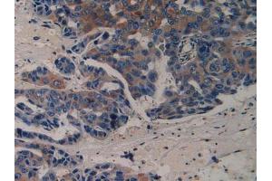 IHC-P analysis of Human Breast Cancer Tissue, with DAB staining. (VEGFR2/CD309 antibody  (AA 46-320))