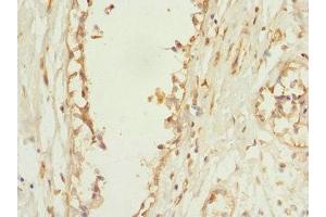 Immunohistochemistry of paraffin-embedded human breast cancer using ABIN7163649 at dilution of 1:100 (PLEKHF2 antibody  (AA 1-249))