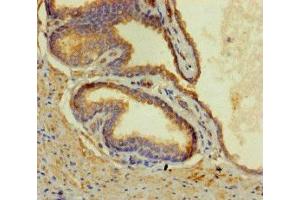 Immunohistochemistry of paraffin-embedded human prostate cancer using ABIN7148597 at dilution of 1:100